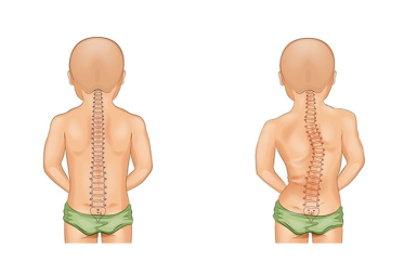 ĐIỀU TRỊ VẸO CỘT SỐNG Ở TRẺ EM: PHÁT HIỆN SỚM – CAN THIỆP ĐÚNG – GIẢM THIỂU BIẾN CHỨNG LÂU DÀI