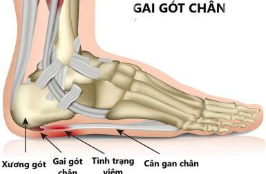 GAI GÓT CHÂN: ĐỪNG ĐỂ MỖI BƯỚC ĐI TRỞ THÀNH CỰC HÌNH – HÃY ĐIỀU TRỊ DỨT ĐIỂM CHỈ SAU 5-7 BUỔI TẠI VIETREHAB