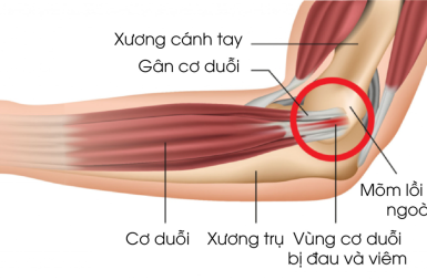 TENNIS ELBOW – VIÊM LỒI CẦU NGOÀI: ĐỪNG ĐỂ CƠN ĐAU ÂM Ỉ LÀM GIÁN ĐOẠN CUỘC SỐNG CỦA BẠN
