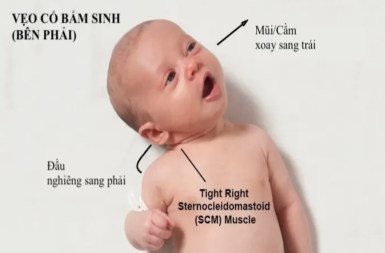 VẸO CỔ SƠ SINH – ĐỪNG ĐỂ TRẺ CHỊU THIỆT VÌ CHẬM TRỄ ĐIỀU TRỊ