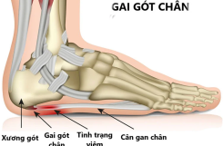 GAI GÓT CHÂN: ĐỪNG ĐỂ MỖI BƯỚC ĐI TRỞ THÀNH CỰC HÌNH – HÃY ĐIỀU TRỊ DỨT ĐIỂM CHỈ SAU 5-7 BUỔI TẠI VIETREHAB