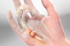 BỆNH LÝ NGÓN TAY LÒ XO: HIỂU ĐÚNG ĐỂ ĐIỀU TRỊ HIỆU QUẢ