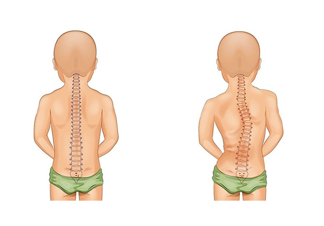 ĐIỀU TRỊ VẸO CỘT SỐNG Ở TRẺ EM: PHÁT HIỆN SỚM – CAN THIỆP ĐÚNG – GIẢM THIỂU BIẾN CHỨNG LÂU DÀI